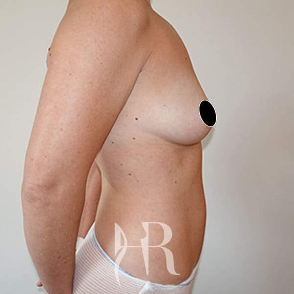 HR Plastic Surgery - Breast Enlargement patient before 11